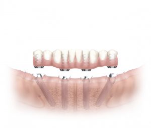all on 4 lower jaw diagram