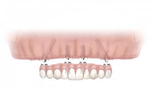 All on 4 upper jaw diagram