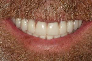 clean perfect smile after all on 4 treatment