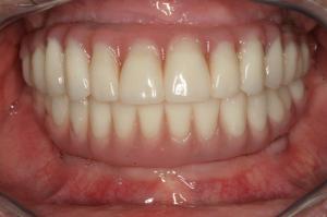 clean perfect smile after all on 4 treatment