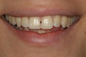 restored front tooth after bonding