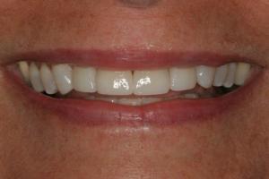 bright new smile after veneers