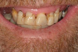 worn smile in need of restoration