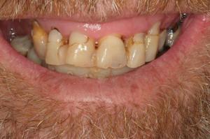 worn smile in need of restoration