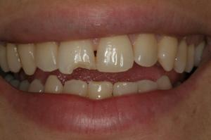 Chipped front tooth before bonding