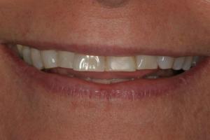 thin worn smile before veneers